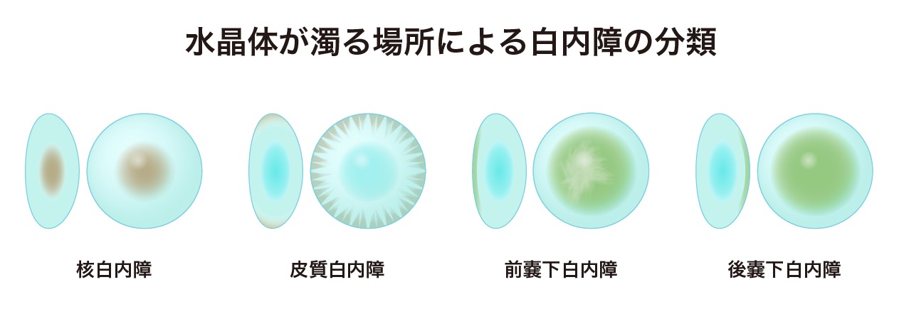 白内障は手術でよってのみ治療することができます | 白内障治療専門サイト アイケアクリニック